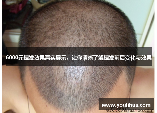 6000元植发效果真实展示，让你清晰了解植发前后变化与效果