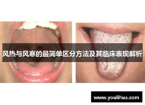 风热与风寒的最简单区分方法及其临床表现解析